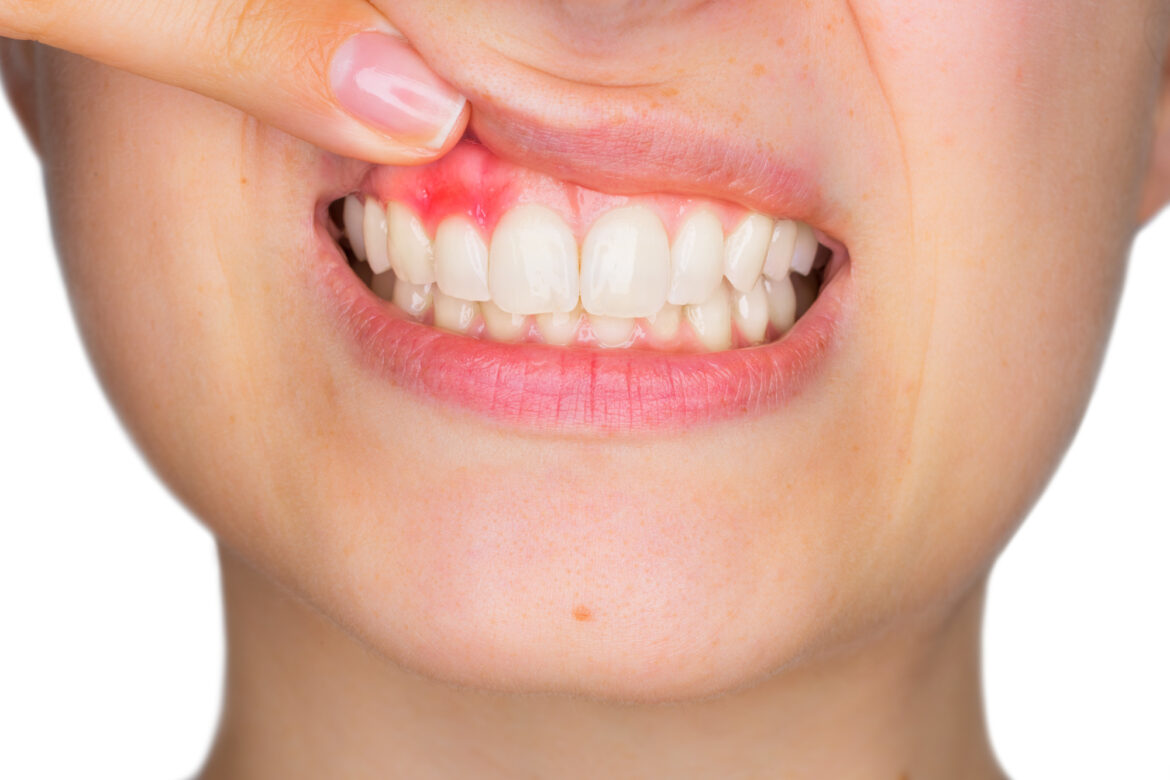 Experiencing bleeding gums when brushing can be alarming. Thankfully, there are a handful of helpful tips and practices that prevent this problem all together.