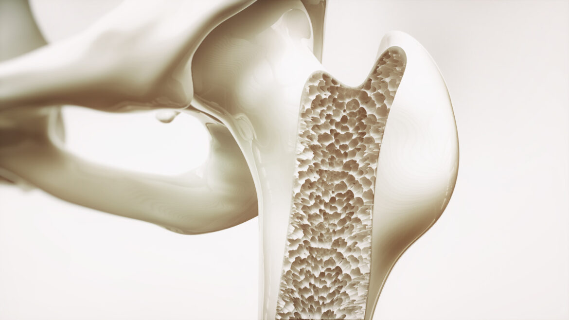 Health Info: What is Osteoporosis?