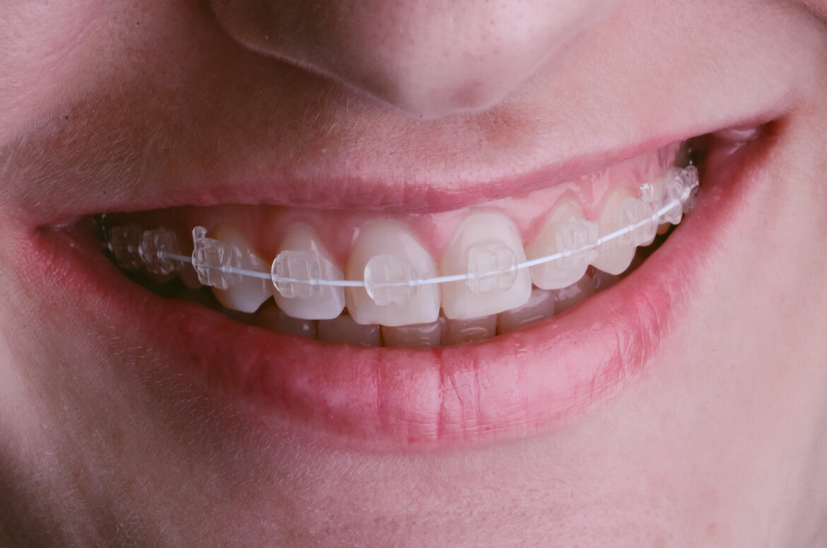 What Are the Different Types of Braces That Exist Today?